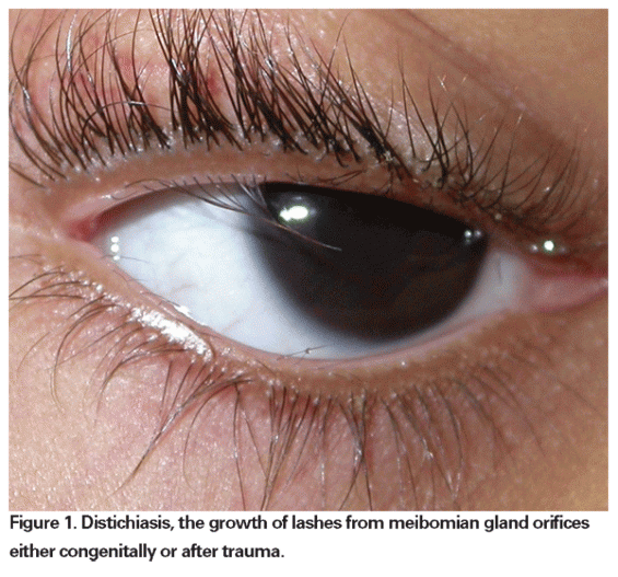 distichiasisdouble rangée de cils