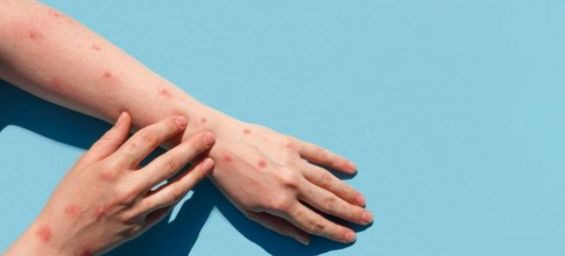 Morocco steps up monkeypox surveillance amid global resurgence