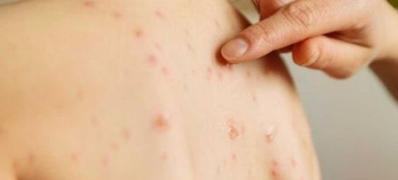 First monkeypox case confirmed in Morocco