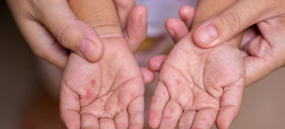 Measles cases in the Netherlands linked to infections imported from Morocco