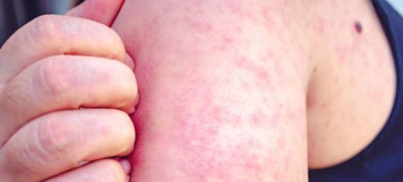 Moroccan variant of the measles virus found in Brussels sewage water