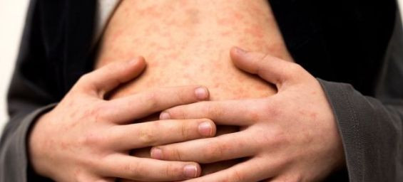Rotterdam school closes after measles outbreak linked to Morocco