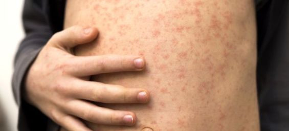 Measles spread in Amsterdam prompts travel advisory for families going to Morocco