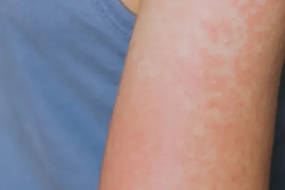 Dutch embassy urges measles vaccination before traveling to Morocco