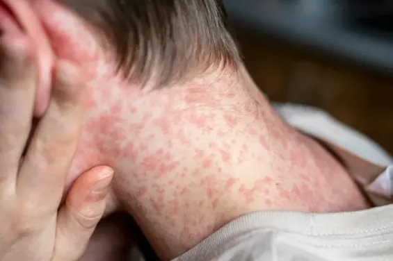 Dutch health authorities link school measles outbreak to Morocco travel