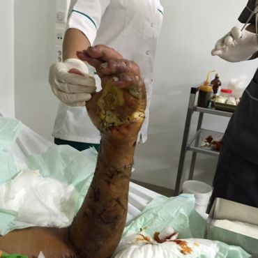 Casablanca : Un chirurgien réussit l’autogreffe d’une main amputée