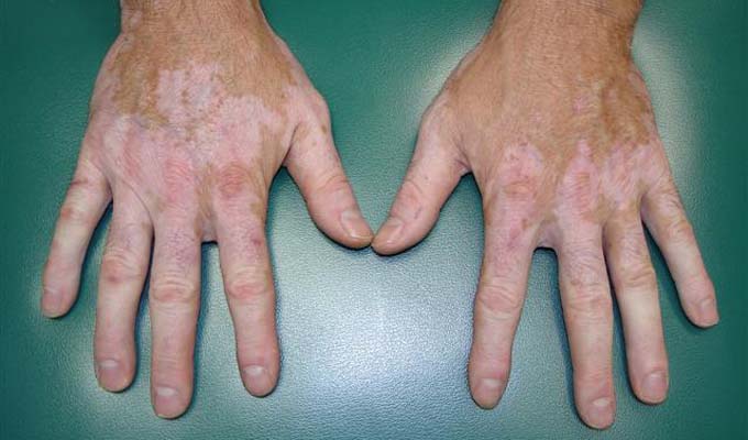 vitiligo maladie de la peau