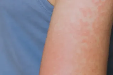 Dutch embassy urges measles vaccination before traveling to Morocco