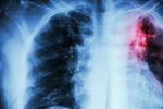 Maroc : Baisse de 33% des nouveaux cas de tuberculose en presque 30 ans
