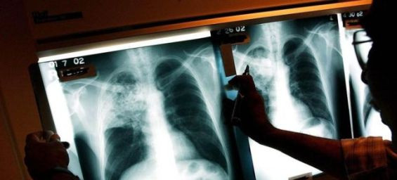 Morocco struggles with rising tuberculosis and drug resistance, with 37,000 cases annually