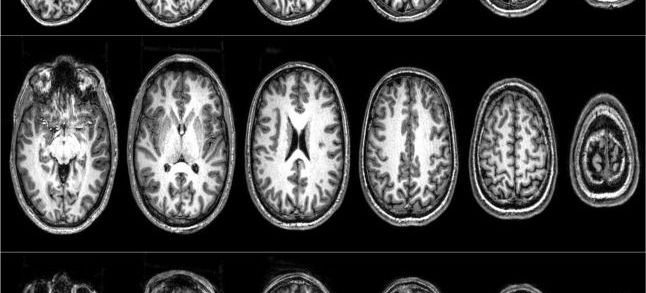 Brain scans from three ‘radicals’ who took part in the Barcelona studies. Brain scans from three 'radicals'. / Ph. Nafees Hamid and Clara Pretus