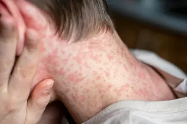 Dutch health authorities link school measles outbreak to Morocco travel