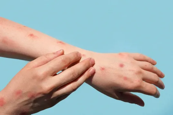 78% of imported measles cases in Spain trace back to Morocco
